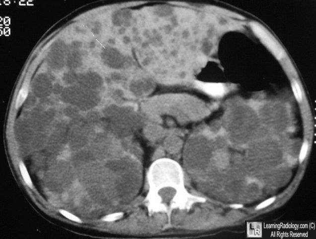 Polycystic Kidney dz